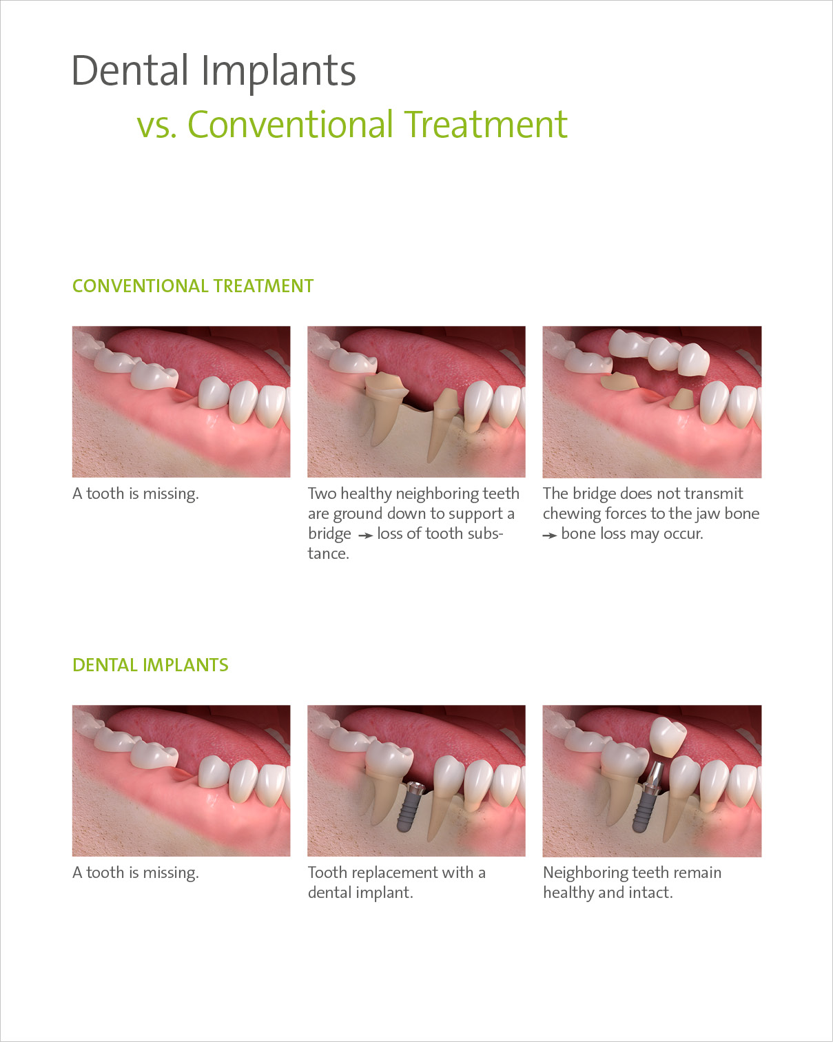 About Dental Implants (2)