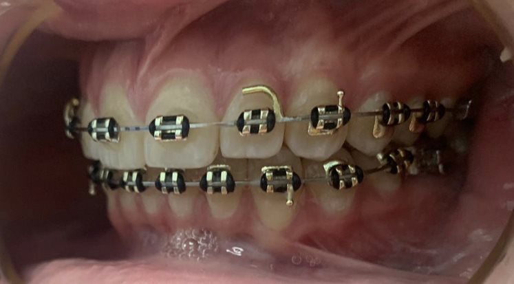 Braces (1)