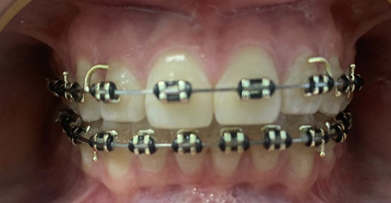 Braces (2)