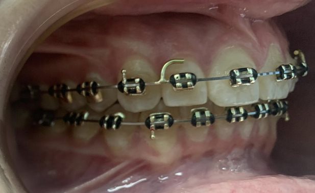 Braces (3)